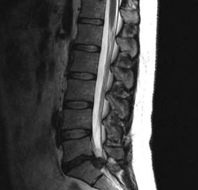 Diagnostikas iespējas jostas osteohondrozei