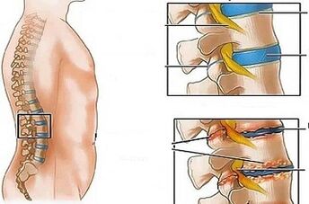 Jostas osteohondrozes attīstības iemesli