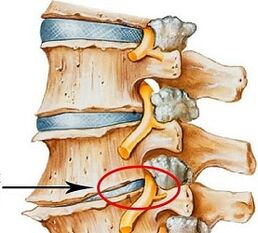Kāpēc ir jostas osteohondroze