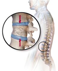 Osteoporoze provocē muguras sāpes muguras lejasdaļā